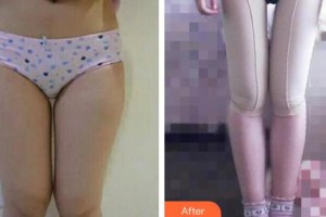 成都唯羅納醫(yī)療美容門(mén)診部李從從整形價(jià)格表附吸脂瘦大腿案例展示