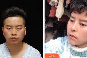 成都市錦江區(qū)第二人民醫(yī)院醫(yī)學(xué)美容科李蓉整形價(jià)格表附鼻部手術(shù)案例展示