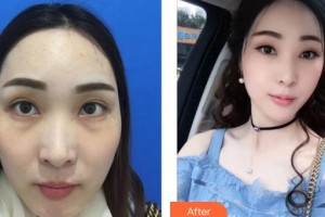 成都藝星醫(yī)療美容醫(yī)院蒲于紅整形價(jià)格表附激光去眼袋案例展示