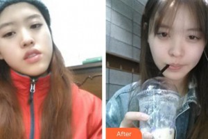 成都俏百顏美容整形醫(yī)院張強(qiáng)整形價(jià)格表附自體脂肪全臉填充案例展示