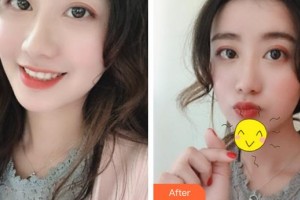 成都元辰醫(yī)學(xué)美容門(mén)診部巫國(guó)輝 整形價(jià)格表附面部填充案例展示