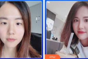 成都市錦江區(qū)第二人民醫(yī)院醫(yī)學(xué)美容科安娜整形價(jià)格表附眼部手術(shù)案例展示