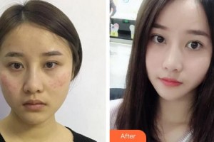 成都艾米麗醫(yī)療美容門(mén)診部秦小梅整形價(jià)格表附超激光美膚祛斑案例展示