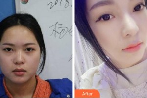 成都華顏醫(yī)療美容門(mén)診部胡宇昆整形價(jià)格表附鼻部手術(shù)案例展示