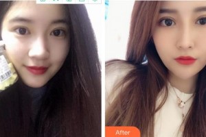 成都百齡駐顏醫(yī)學(xué)美容門(mén)診部劉祎整形價(jià)格表附雙眼皮 眼部手術(shù)案例展示