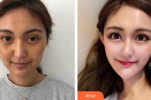 成都菲格醫(yī)療美容門(mén)診部陳謝娟整形價(jià)格表附超激光美膚祛斑案例展示