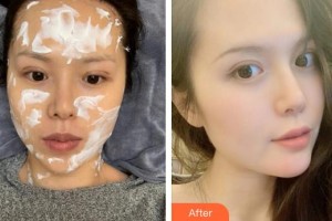 成都春天醫(yī)療美容門(mén)診部許麗君整形價(jià)格表附熱瑪吉案例展示