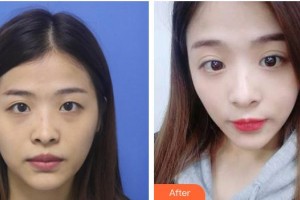 成都晶膚醫(yī)學(xué)美容醫(yī)院鄭勝國(guó)整形價(jià)格表附不開(kāi)刀雙眼皮案例展示
