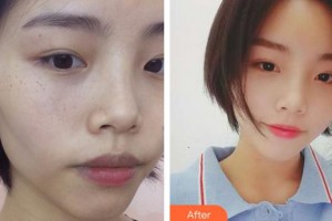 成都晶膚醫(yī)學(xué)美容醫(yī)院趙一謙整形價格表附祛雀斑案例展示