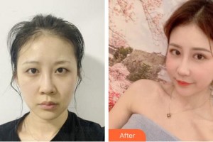 成都唯羅納醫(yī)療美容門診部高海燕整形價格表附鼻部手術(shù)案例展示