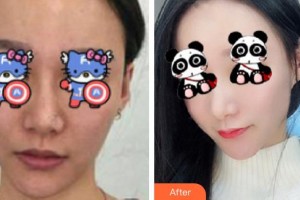 成都晶膚醫(yī)學(xué)美容醫(yī)院陳佳整形價格表附光子嫩膚案例展示