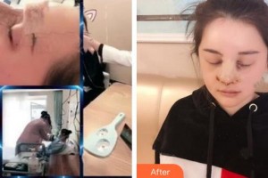 成都利美康爵麗醫(yī)療美容門診部薛塬峰整形價格表附隆鼻案例展示