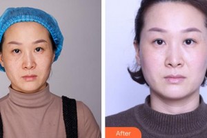 成都唯羅納醫(yī)療美容門診部李士武整形價格表附超激光美膚祛斑案例展示