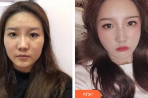 成都黃氏百佳整形醫(yī)院顏明輝整形價格表附埋線提升提升案例展示