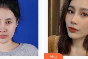 成都利美康爵麗醫(yī)療美容門診部梁靜萍整形價格表附埋線提升案例展示