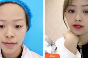 成都明星醫(yī)療美容門診部于海成整形價格表附眼部手術(shù)案例展示