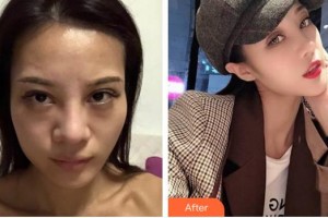 成都黃氏百佳整形醫(yī)院汪秦整形價格表附隆鼻案例展示