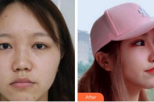 成都景華醫(yī)學(xué)美容門診部江濤整形價格表附鼻部手術(shù)案例展示