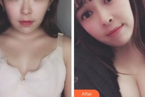 成都景華醫(yī)學(xué)美容門診部趙景華整形價格表附濃縮豐胸真實案例展示