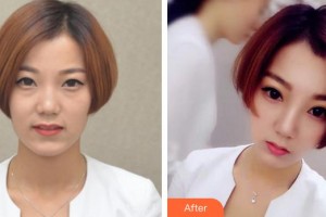 成都明星醫(yī)療美容門診部黃曉光整形價格表附眼部綜合案例展示