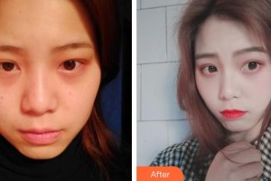 成都艾米麗醫(yī)療美容門診部劉叔陽整形價格表附眼部綜合案例展示