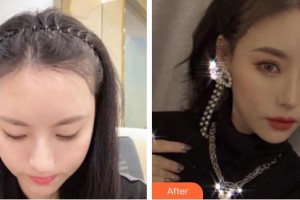 成都景華醫(yī)學(xué)美容門診部楊杰整形價格表附發(fā)際線案例展示