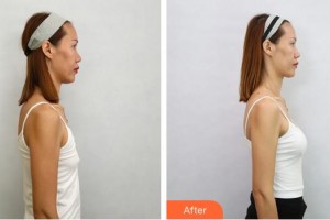 成都瑞美薈醫(yī)療美容醫(yī)院王家勇整形價格表附假體隆胸案例展示