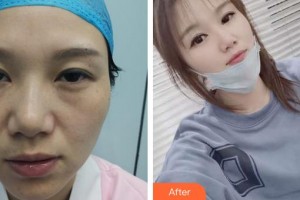 成都柏菲絲醫(yī)學(xué)美容門診部蘇瑋智整形價格表附面部吸脂案例展示