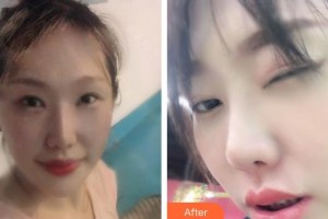 成都明星醫(yī)療美容門診部楊建昌整形價格表附埋線提升案例展示