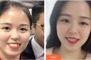 成都景華醫(yī)學(xué)美容門診部華越整形價格表附牙綜合案例展示