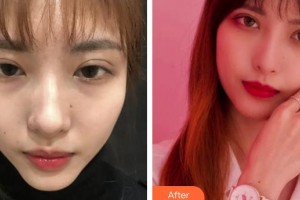 成都柏菲絲醫(yī)學(xué)美容門診部陳思凱整形價格表附面部逆埋線提升造出小V臉案例展示