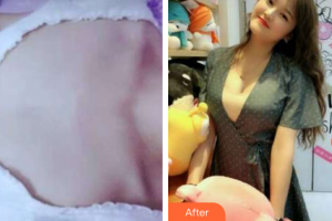 成都軍建醫(yī)院整形美容中心楊俊整形價(jià)格表附隆胸案例展示