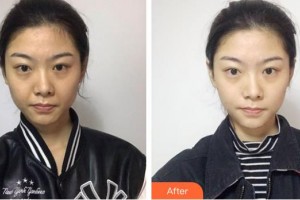 成都瑞美薈醫(yī)療美容醫(yī)院黃薪整形價(jià)格表附埋線提升案例展示