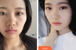 成都瑞美薈醫(yī)療美容醫(yī)院董理整形價(jià)格表附鼻部手術(shù)案例展示