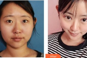 成都維莎芬美容整形醫(yī)院崔賢鎰?wù)蝺r(jià)格表附眼部綜合案例展示