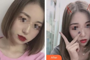 成都赫拉醫(yī)療美容整形醫(yī)院曾俊君整形價(jià)格表附下頜緣瘦臉術(shù)案例展示