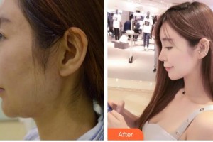 成都美卿醫(yī)療美容醫(yī)院凱恩整形價(jià)格表附面部環(huán)吸案例展示