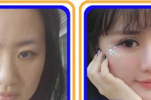 成都如悅醫(yī)療美容醫(yī)院徐進(jìn)整形價(jià)格表附眼部手術(shù)+脂肪案例展示