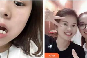 成都拜博拜爾口腔醫(yī)院詹瀚整形價(jià)格表附牙齒矯正案例展示