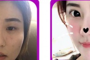 成都江華美整形美容醫(yī)院周棋林整形價(jià)格表附眼部綜合案例展示