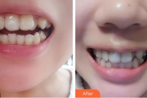 成都唐牙科門(mén)診部周麗容整形價(jià)格表附牙齒矯正案例展示