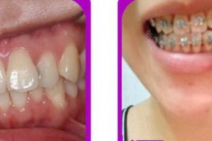 成都華美牙科悅齒門(mén)診部鐘果成整形價(jià)格表附牙齒矯正案例展示