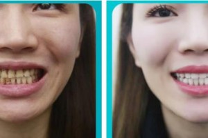 成都華美牙科悅齒門(mén)診部田洪君整形價(jià)格表附牙齒美白案例展示