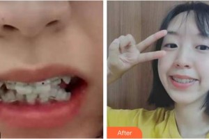成都華美牙科悅齒門(mén)診部劉永桂整形價(jià)格表附牙齒矯正案例展示
