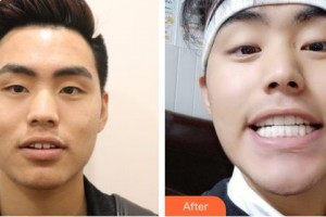 成都瑞泰融誠(chéng)口腔醫(yī)院劉澤萍整形價(jià)格表附牙齒縫隙矯正案例展示