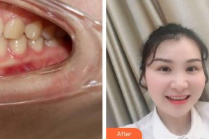 成都瑞泰融誠(chéng)口腔醫(yī)院孫勁東整形價(jià)格表附半隱形牙齒矯正案例展示