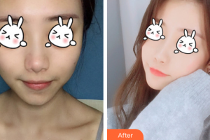 廣州海峽醫(yī)學整形美容醫(yī)院廖奇峰整形價格表附光子嫩膚案例展示