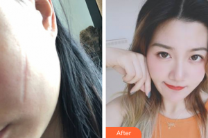 廣州紫馨美容醫(yī)院富士森整形價格表附手術祛疤案例展示