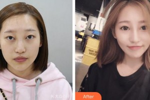 成都西區(qū)醫(yī)院醫(yī)學(xué)美容科鄧東偉整形價(jià)格表附埋線雙眼皮+鼻部手術(shù)案例展示