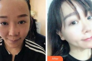 成都首瑞毛發(fā)移植醫(yī)療美容診所汪軍院長(zhǎng)整形價(jià)格表附植發(fā)案例展示